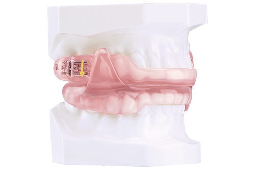 The image shows a close-up of a dental model with an open mouth, featuring a pink tooth and a yellow filling.