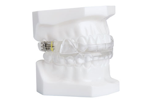The image displays a transparent, 3D-printed dental implant with a visible yellow screw, set against a white background.