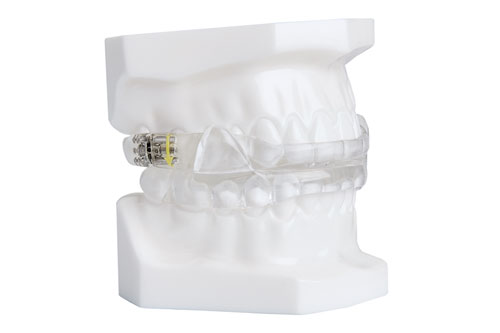 The image shows a clear, plastic dental model with a set of upper and lower teeth, including a single tooth with a yellowish-brown filling in the middle.