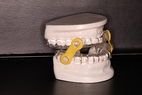 The image shows a set of clear, plastic dentures with yellow clasps and a metal base, placed on a black surface.