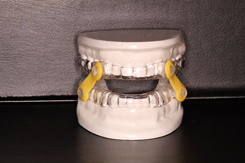 The image shows a dental impression tray with a yellow handle, placed on a surface.
