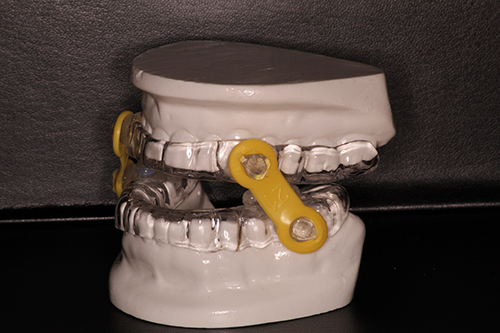The image shows a set of clear braces with yellow elastics, placed on a model of a human upper dentition against a dark background.