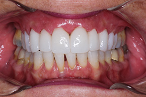 The image shows a person s mouth with a set of teeth, including the upper and lower dental arches.