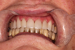 A person wearing a clear oral appliance with multiple teeth visible, showcasing the device used for dental treatment or correction.