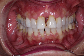 The image shows a close-up of an individual s mouth with teeth and gums.