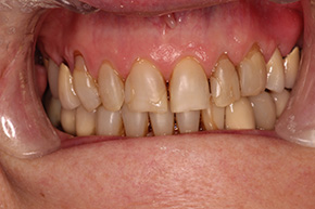 Smiling mouth with teeth showing, displaying a dental treatment or cosmetic enhancement.