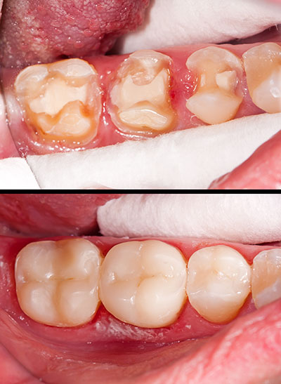 The image shows a close-up of an open mouth with teeth that appear to be in poor condition, possibly due to decay or gum disease, and the surrounding area is inflamed.