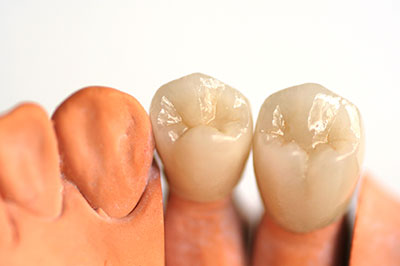 An image of a set of artificial teeth placed next to each other, showcasing different shades and textures.