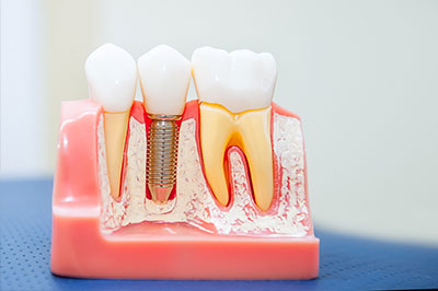 An image of a dental model with multiple teeth, showcasing a variety of dental implant types and colors, with a focus on the screws used to secure them in place.