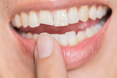 Alt text  A close-up of a person s smiling mouth with teeth, holding a finger over the mouth.