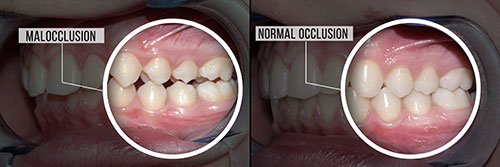 The image shows a side-by-side comparison of a human mouth with teeth before and after a dental procedure, with text labels indicating  normal occlusion  and  malocclusion.