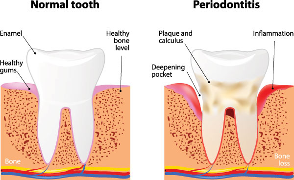 The image shows a diagrammatic representation of the tooth decay process, with labels indicating normal tooth structure and stages of progression to periodontitis.