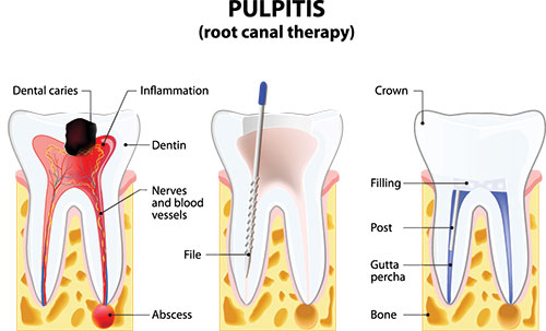 The image is a medical illustration depicting the process of dental pulpitis, showing an affected tooth with inflammation and a needle inserted for treatment.