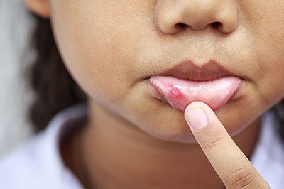 The image shows a close-up of a child s face with an acne treatment applied on their skin, and they are pointing to it.