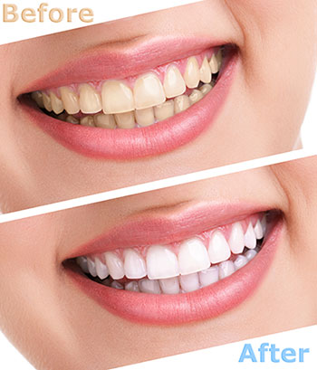 Before and after image of teeth whitening, showing a side-by-side comparison of a person s natural smile with the same individual s smile after a cosmetic dental treatment.