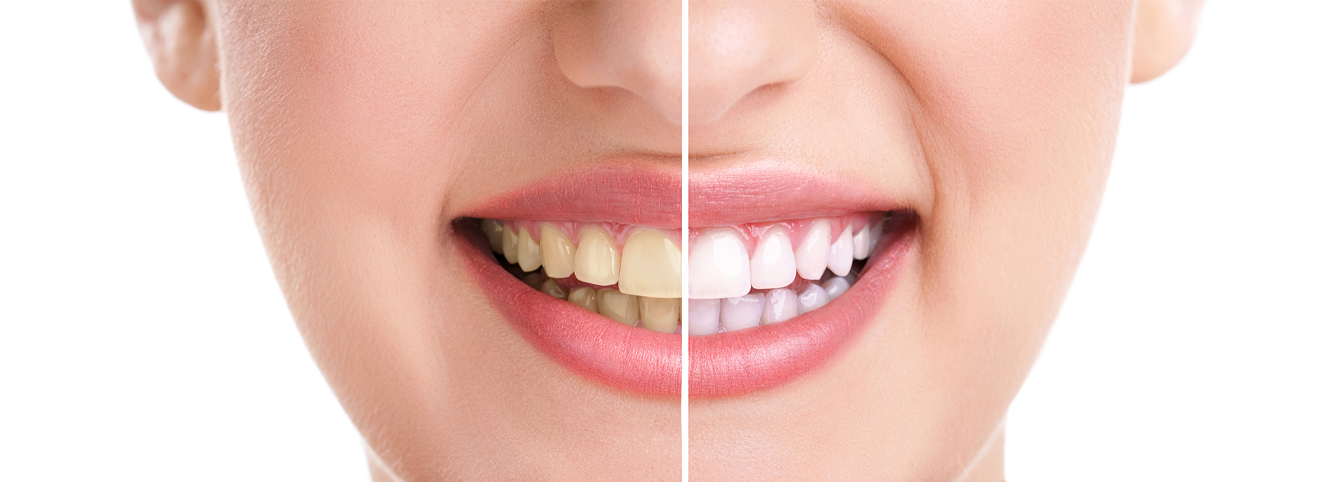 The image shows a close-up of a person s face, highlighting the process of teeth whitening with before and after results.