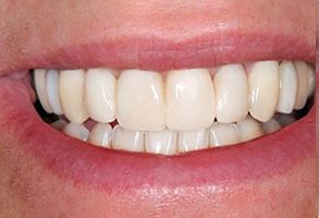 A close-up image of a person s teeth and mouth, showcasing a smile with white fillings.