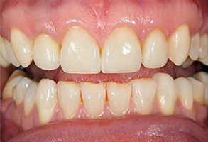 The image shows a close-up of a person s teeth with yellowing and some staining, indicating the need for dental care or possibly the effects of certain medications.