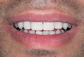 The image shows a close-up of a person s mouth with teeth, smiling slightly.