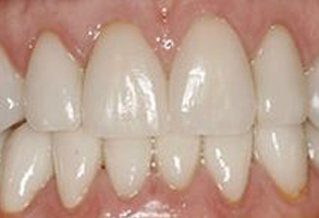 The image shows a close-up of a person's teeth, revealing a yellowish discoloration on the front teeth.