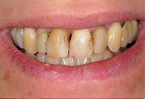 This image shows a person s mouth with yellowed teeth and a partial denture, displaying the upper front teeth.