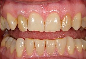 The image shows a close-up of a person s teeth with a focus on the yellowing and wear indicative of poor oral hygiene.