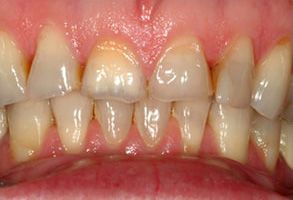 The image displays a close-up of a person s teeth with visible yellowing and staining, indicating poor oral hygiene or dental issues.
